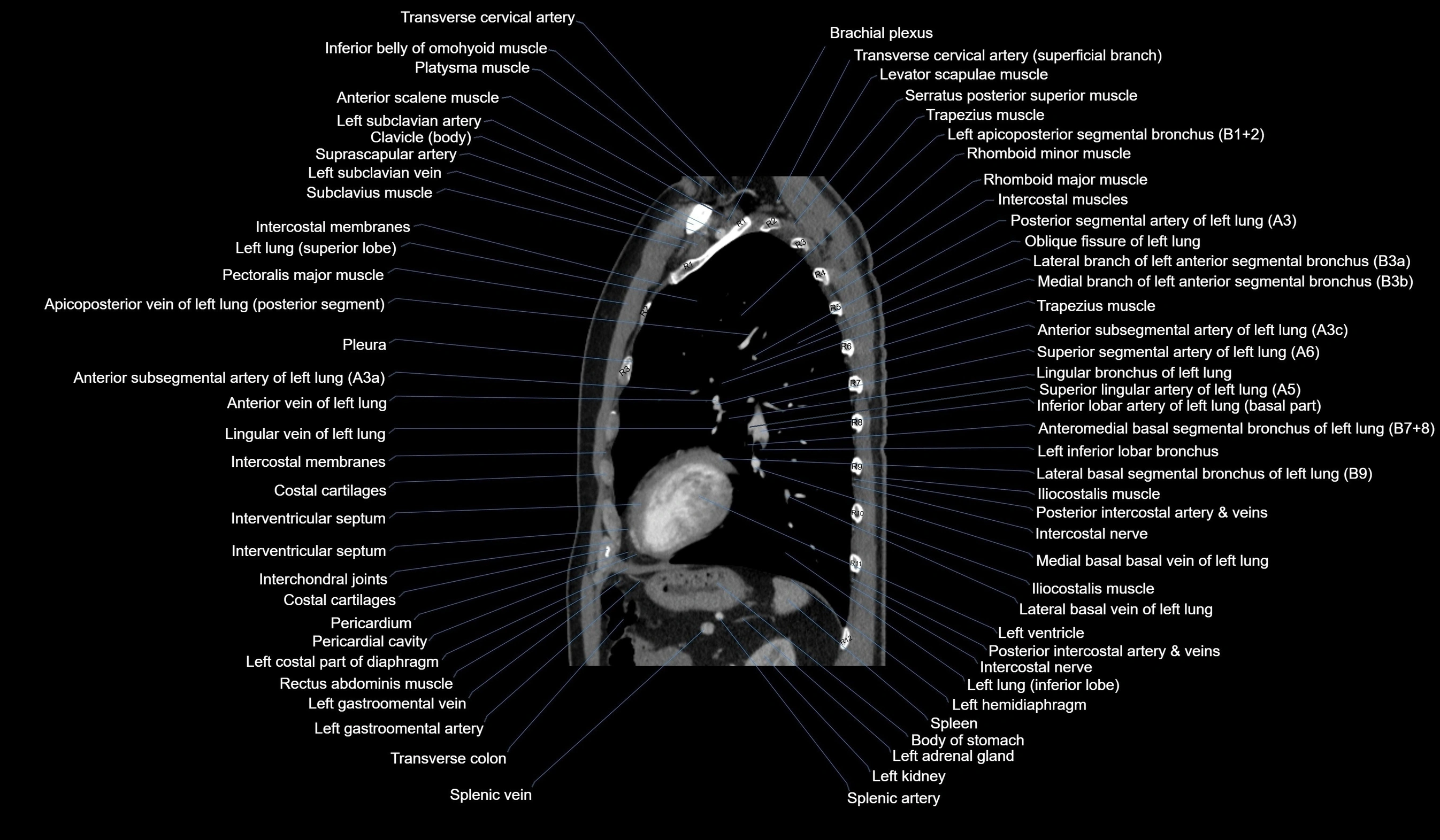 CT chest (thorax) soft tissue window labelled sagittal cross sectional anatomy radiology image-00097.webp